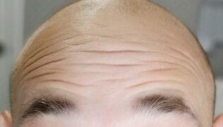 capital aesthetics treating forehead lines for men