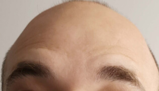 Botox treatment for men to treat forehead lines