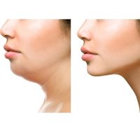before and after results of belkyra fat dissolving treatment for the chin