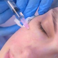 undereye volume restoration with dermal filler for tear trough