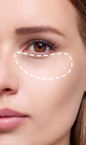treating under eye darkness and hollowness with dermal fillers