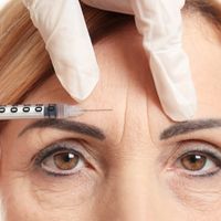 botox for forehead lines