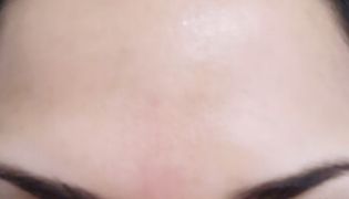 results after botox for forehead