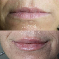 capital aesthetics client testimonial after lip filler treatment