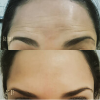 capital aesthetics client testimonials for great forehead lines service