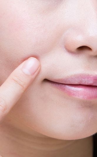 softening signs of aging of nasolabial lines with fillers