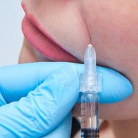 Nasolabial filler service in top beauty clinic in ottawa