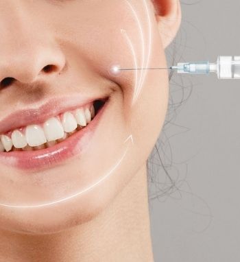 reducing nasolabial lines with filler