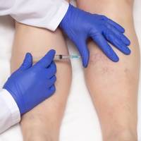 sclerotherapy services