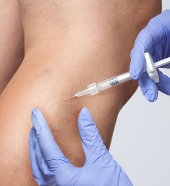 sclerotherapy treatment capital aesthetics