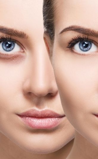 tear trough dermal filler service in ottawa