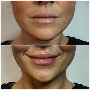 Lip filler before and after the treatment.