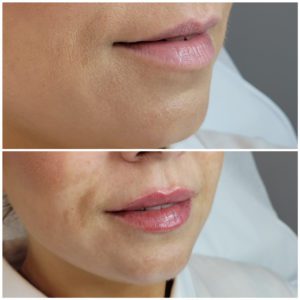 Lip injectable before and after results.