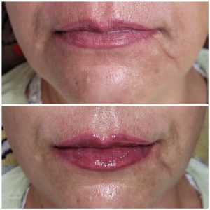 Lip rejuvenation with dermal filler