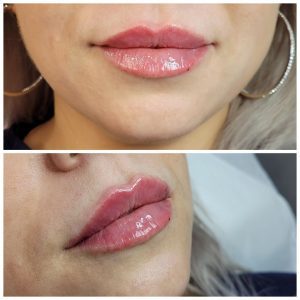 Lip filler before and after treatment with dermal fillers.