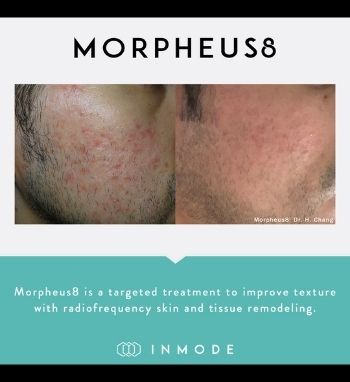 Morpheus8 acne treatment skin tightening 1