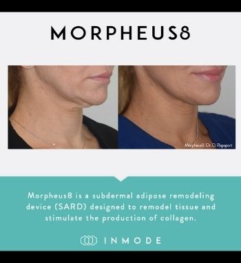 Morpheus8 skin remodeling