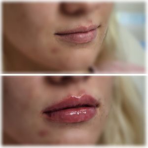 full lips after filler treatment