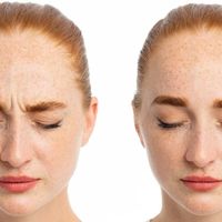 frown lines botox service ottawa