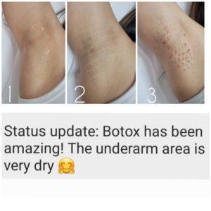 botox for hyperhidrosis