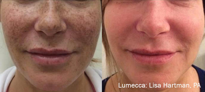 lumecca before after dr l hartman preview 2