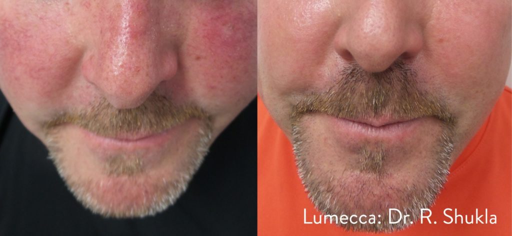 lumecca before after dr r shukla preview 6