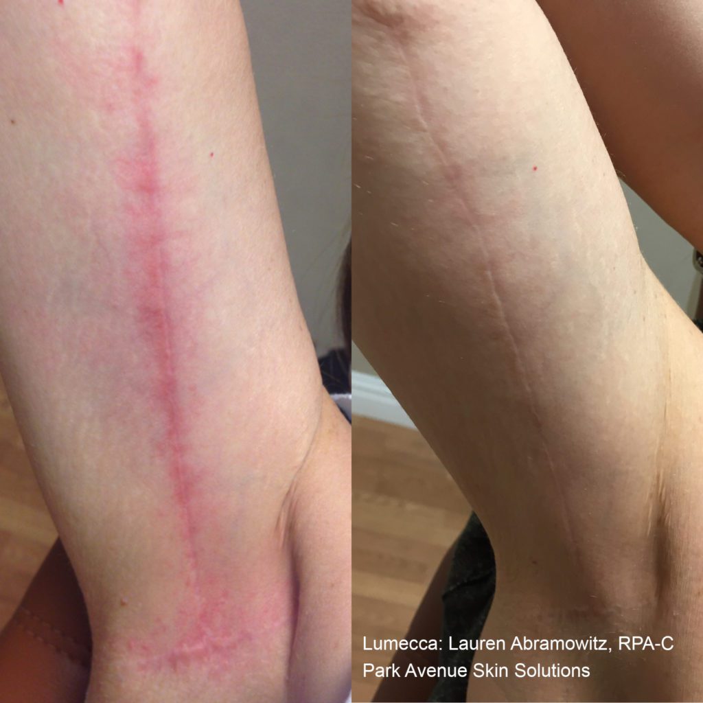 lumecca before after lauren abramowitz rpa c park avenue skin solutions preview 1