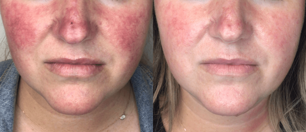 lumecca before after spry skin and wellness preview 1