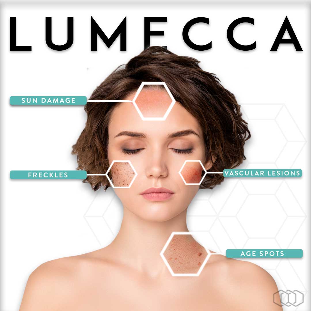 lumecca ipl treatments
