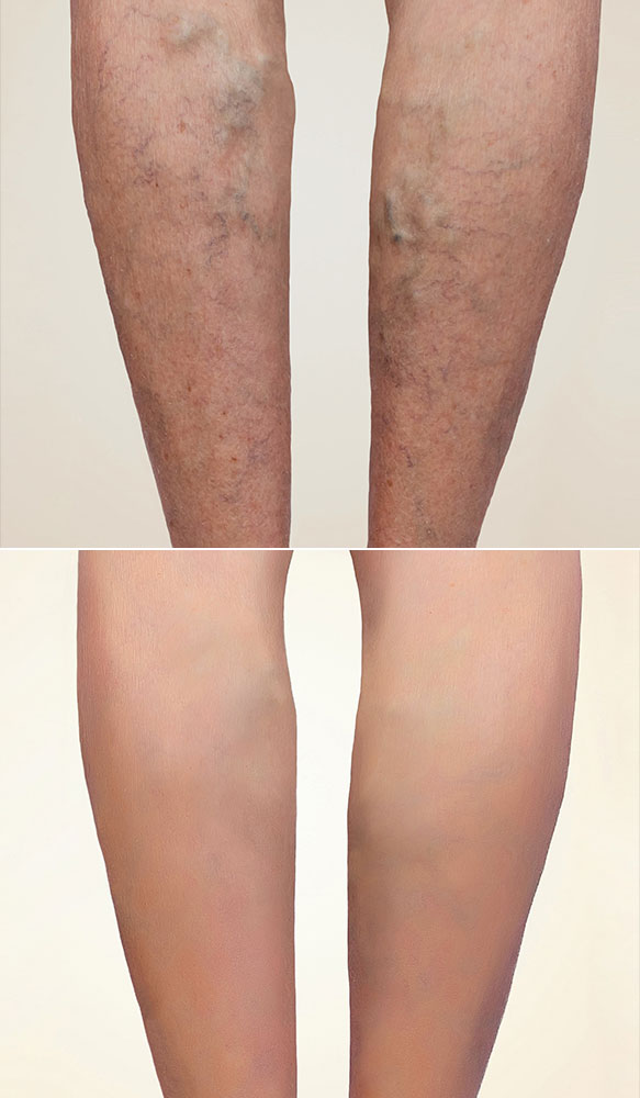 spider veins before after