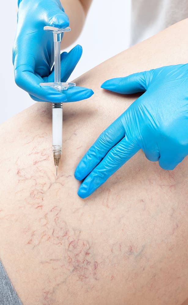 spider veins being fixed with an injection